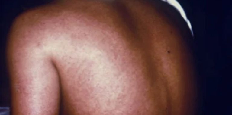 Equatorial Guinea Marburg virus death toll rises to 20
