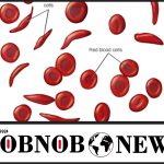 New Cure For Sickle Cell Disease Approved By US Health Agency
